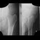 Outlines of gluteal muscles in the hip: X-ray - Plain radiograph